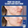 Wiki Special Anti Acne Serum 30ml | Clears Acne & Soothes Skin